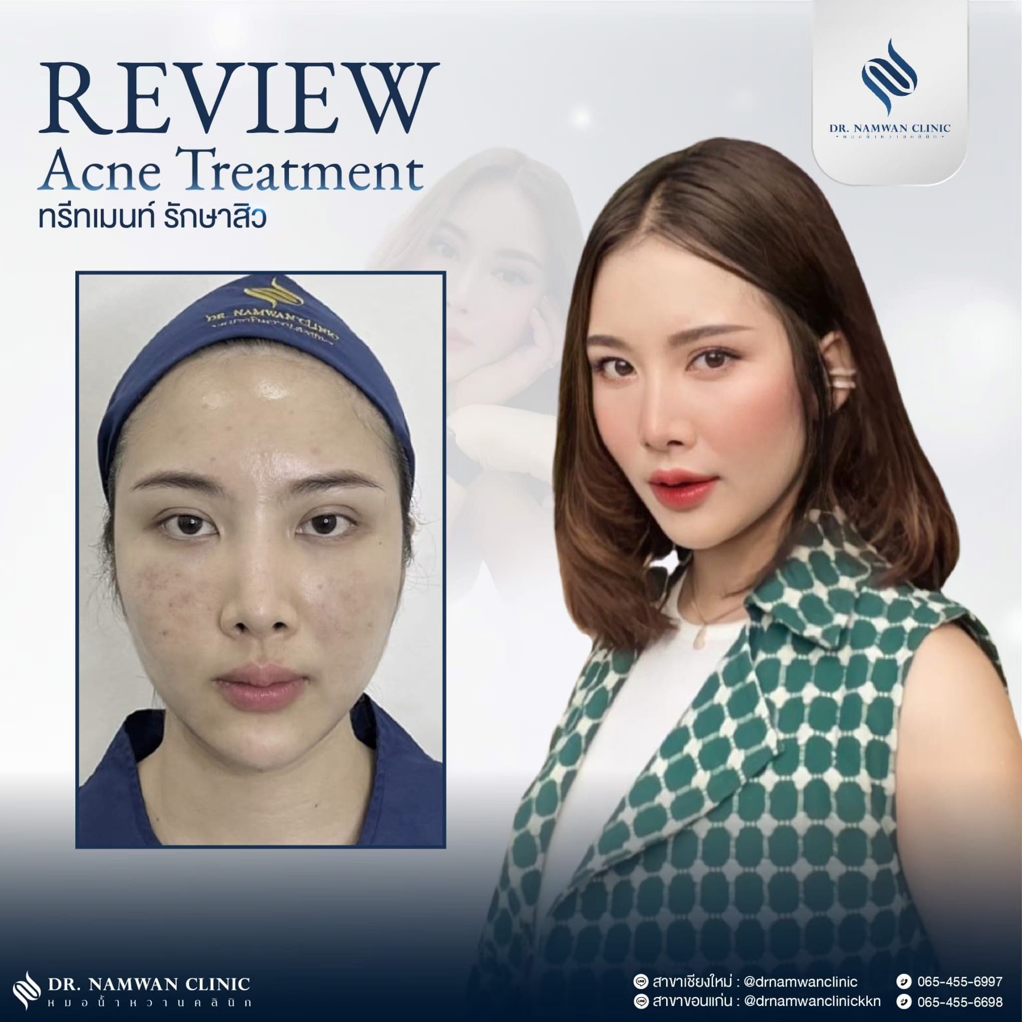 รีวิว รักษาสิว / หน้าใส