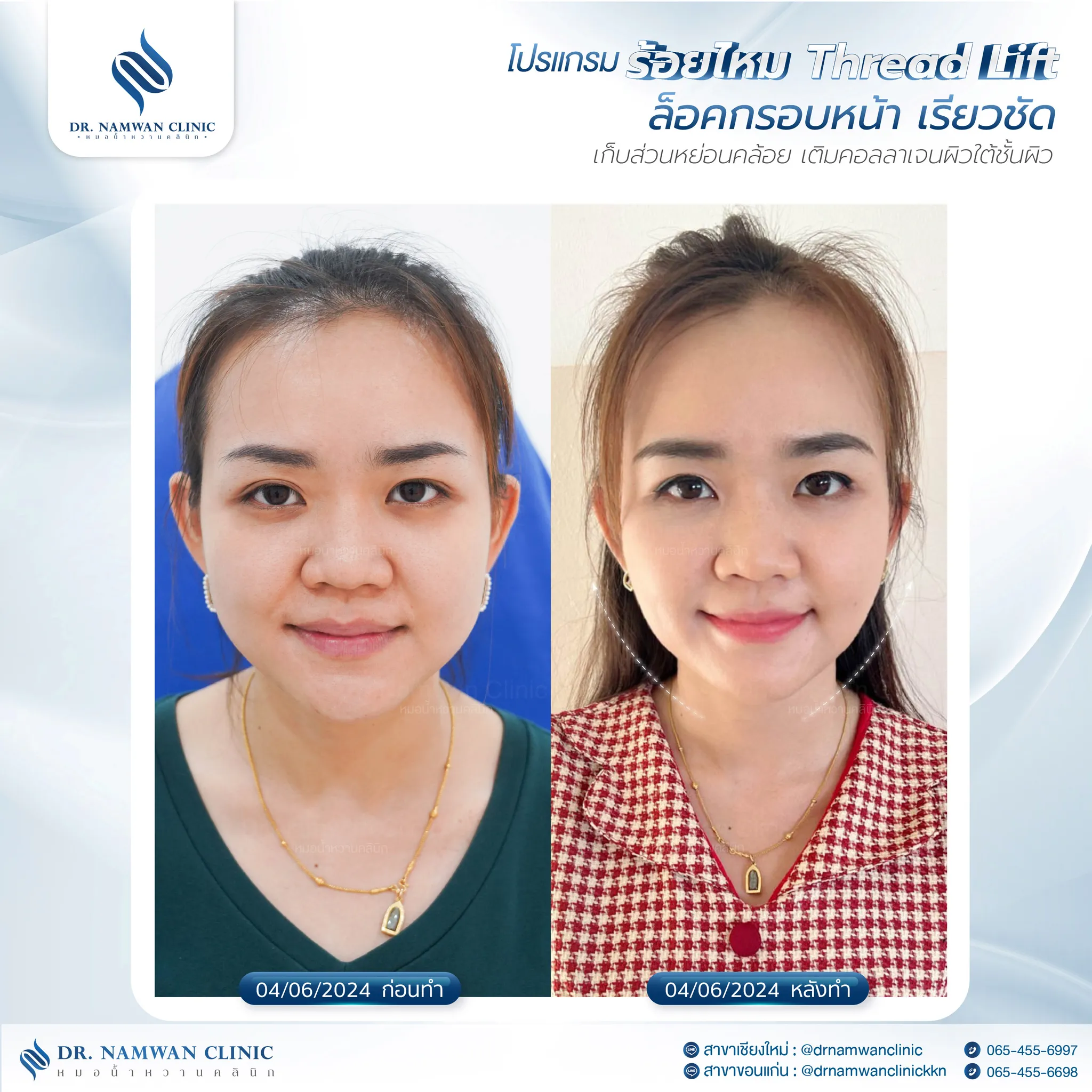ผลลัพธ์ก่อน–หลัง โปรแกรมผลลัพธ์ก่อน–หลัง