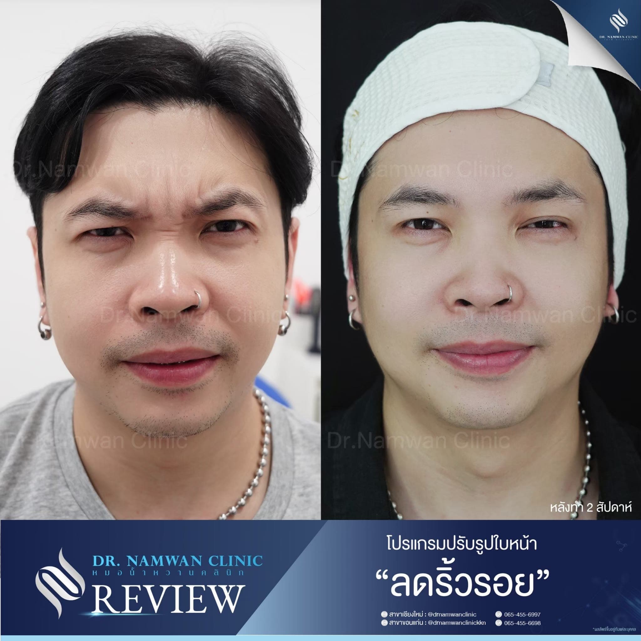 รีวิว ลดริ้วรอย / โบทูลินัม