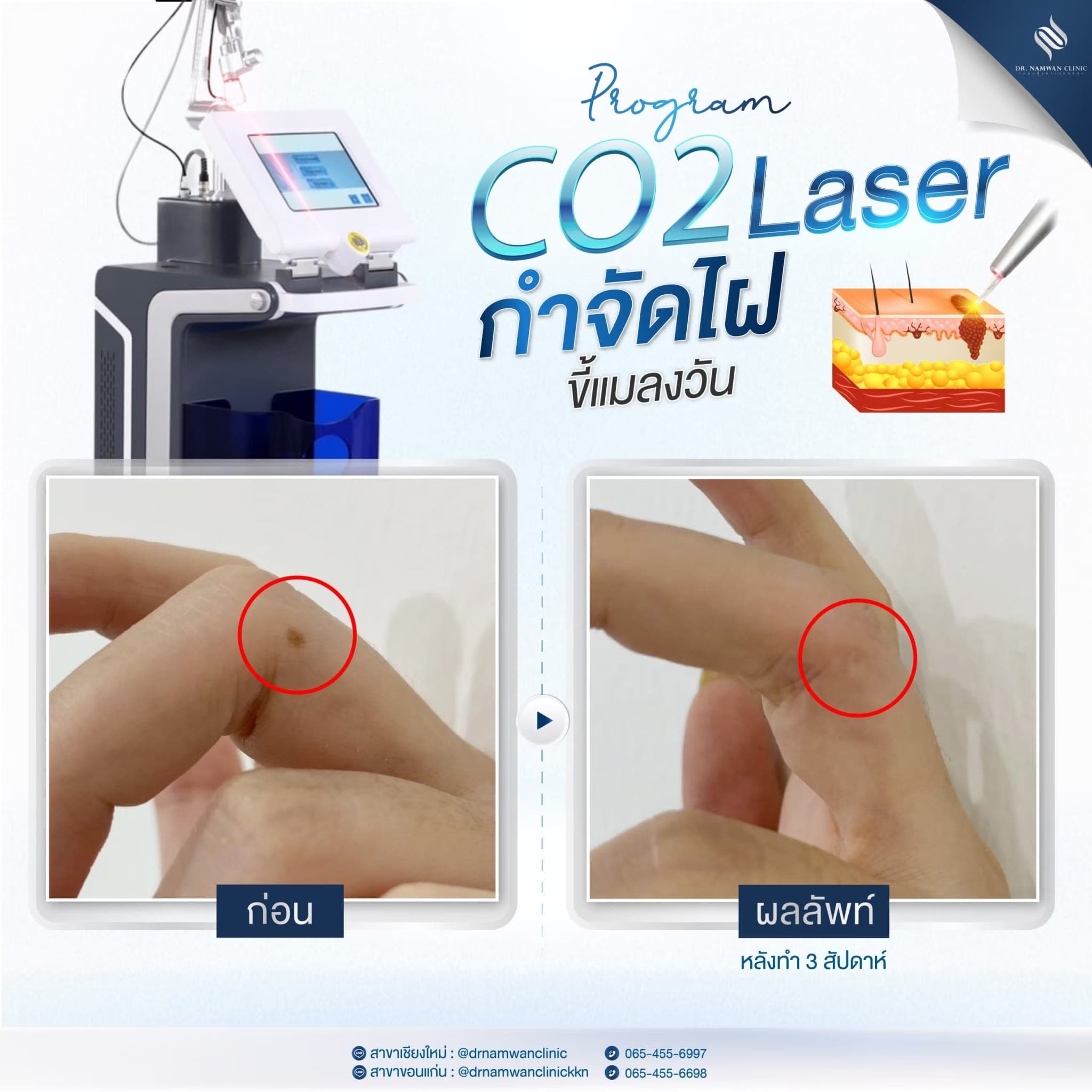 ผลลัพธ์ก่อน–หลัง โปรแกรมCO2 Laser