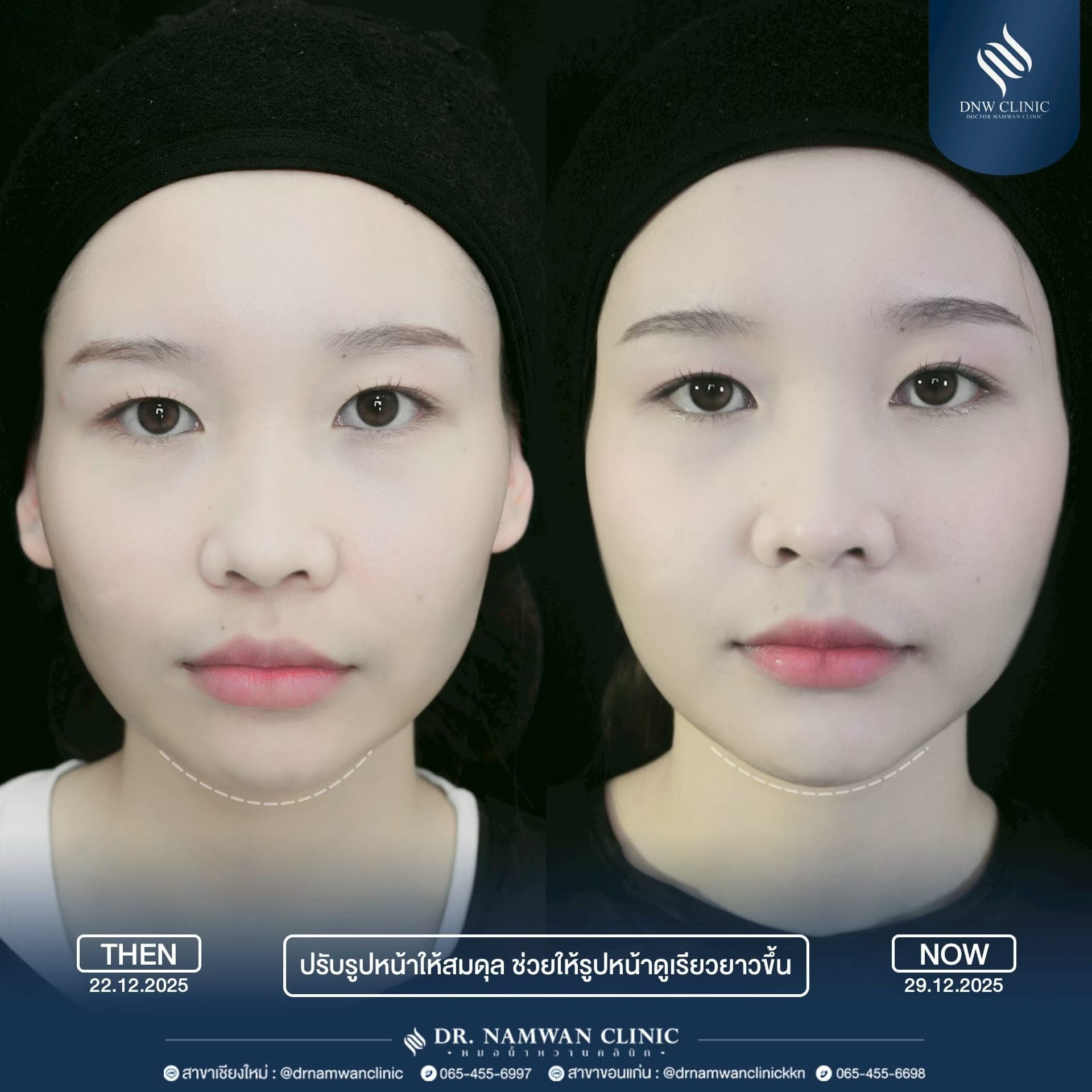 รีวิว ฉีดฟิลเลอร์
