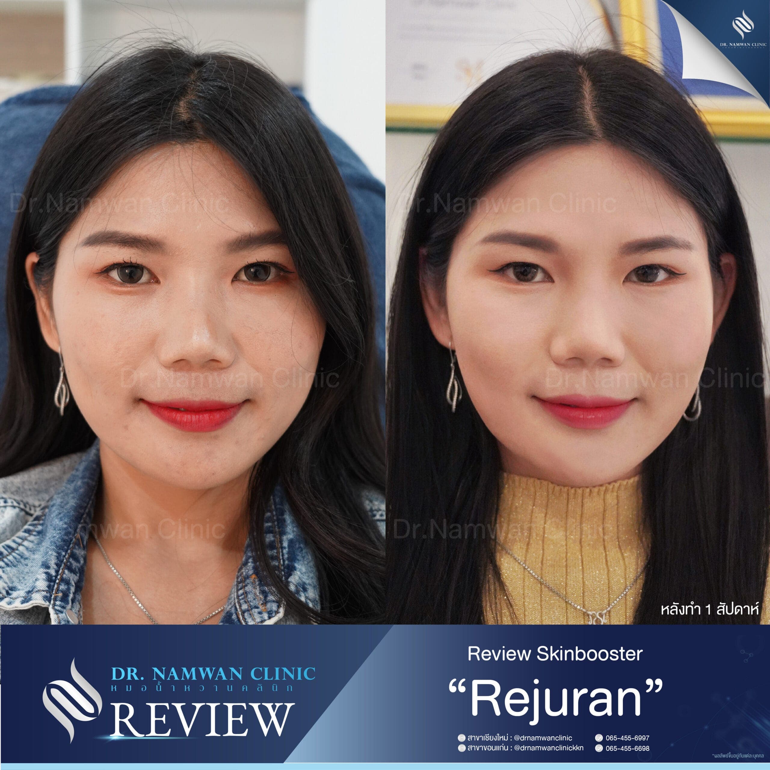 ผลลัพธ์ก่อน–หลัง โปรแกรมRejuran