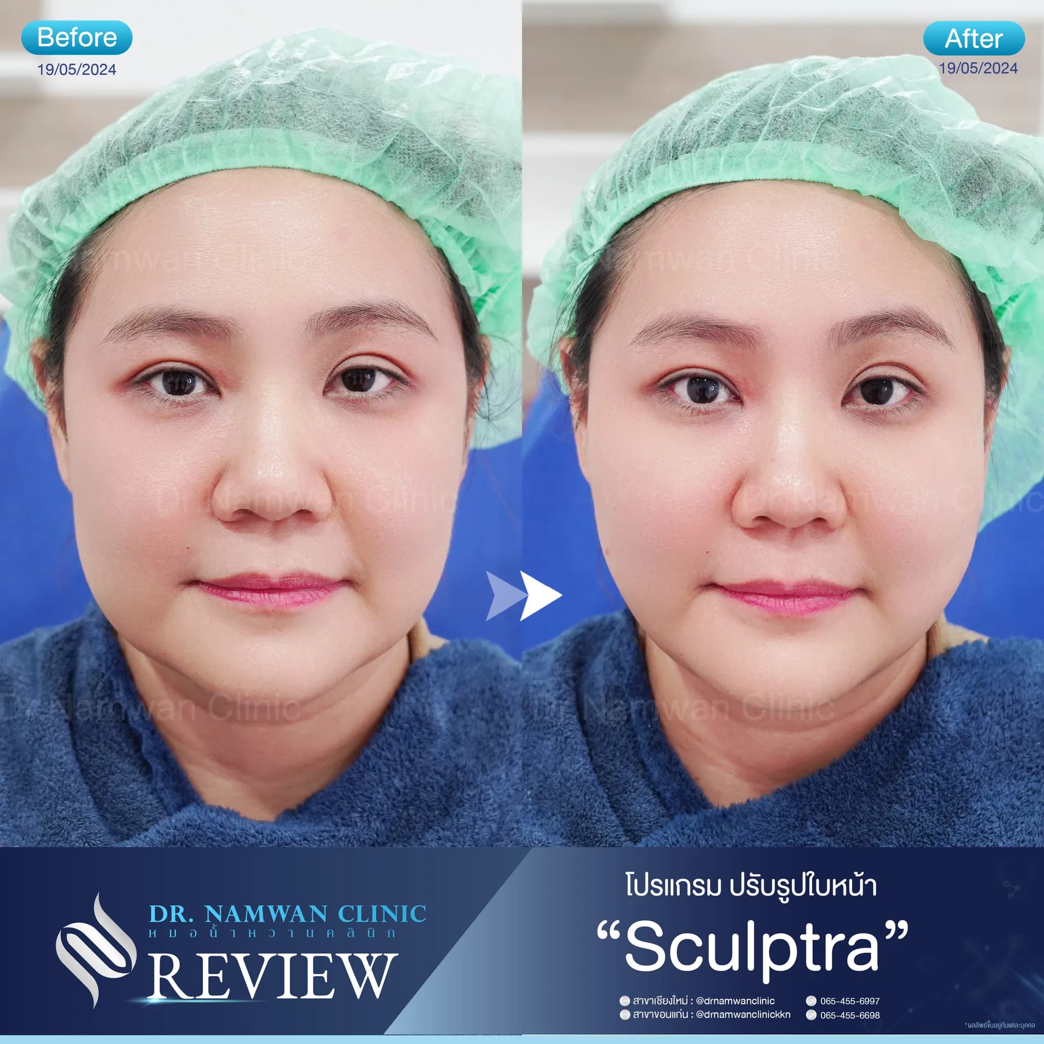 ผลลัพธ์ก่อน–หลัง โปรแกรมSculptra