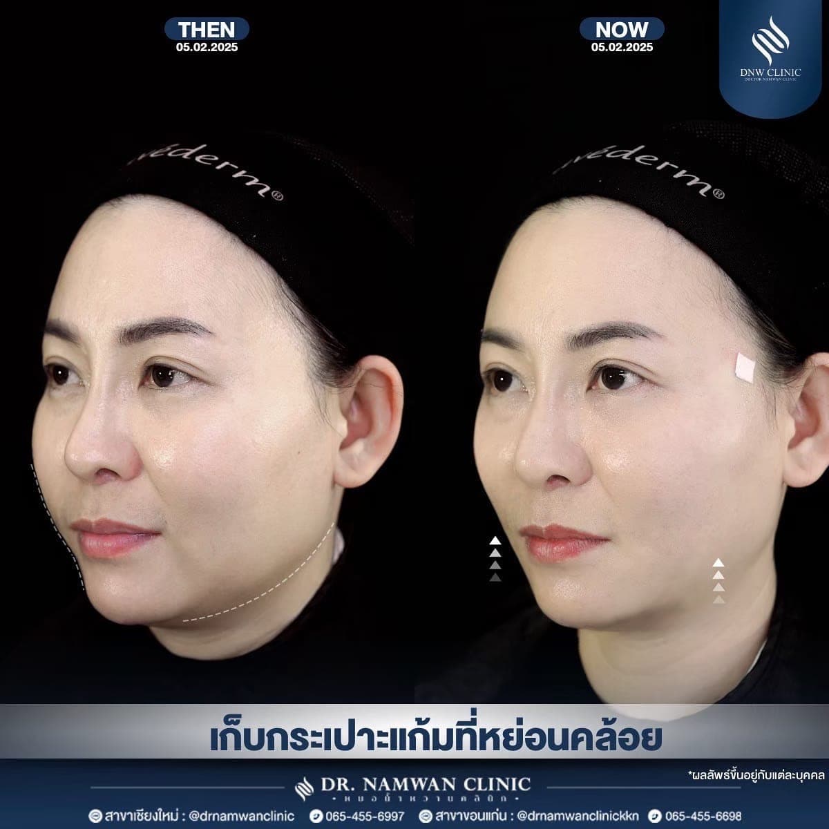 รีวิว ร้อยไหม MINT