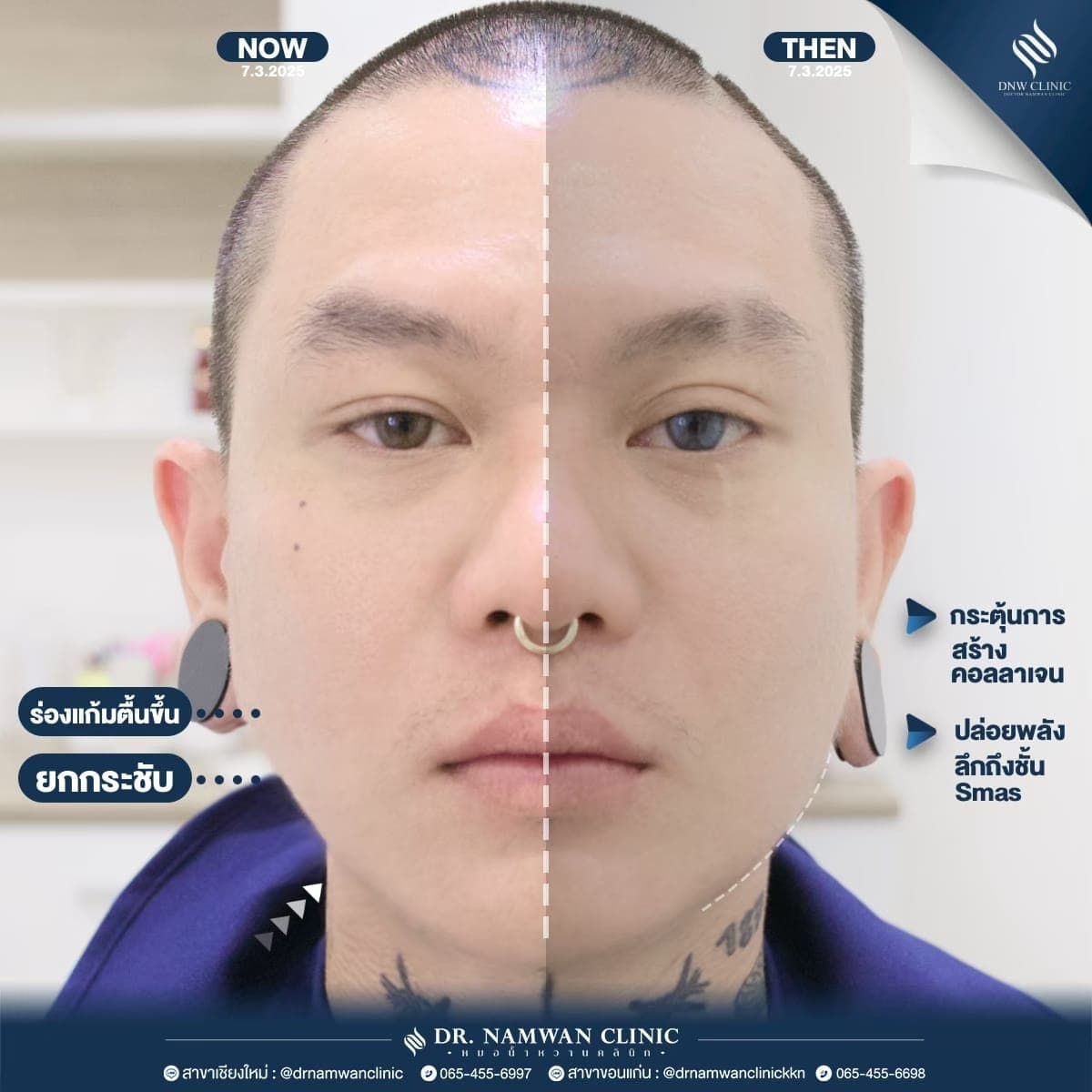 รีวิว Ultra Face Lift