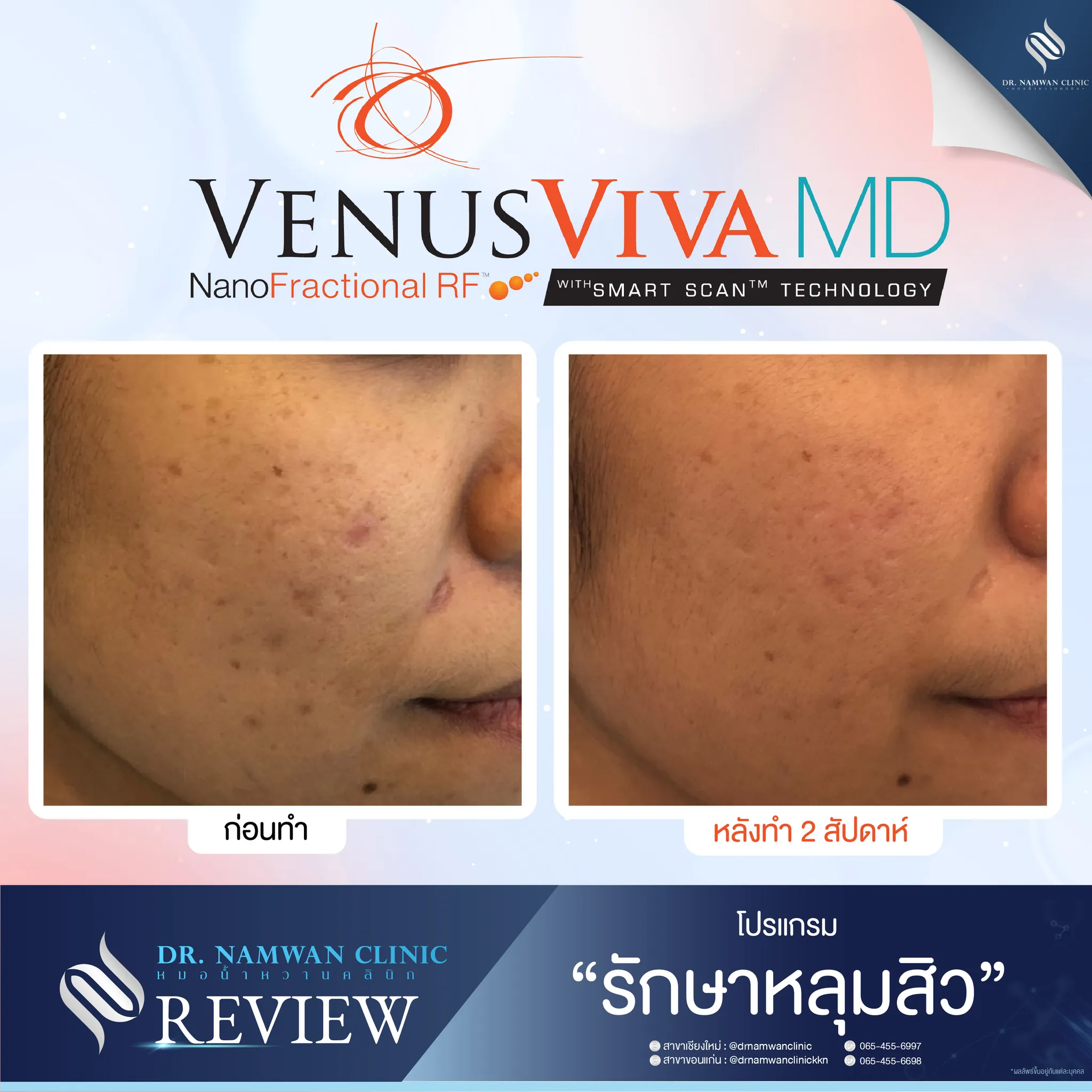ผลลัพธ์ก่อน–หลัง โปรแกรมVenus Viva MD